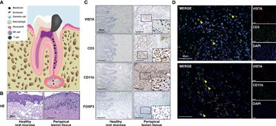 VISTA Blockade Aggravates Bone Loss in Experimental Murine <mark class="highlighted">Apical Periodontitis</mark>